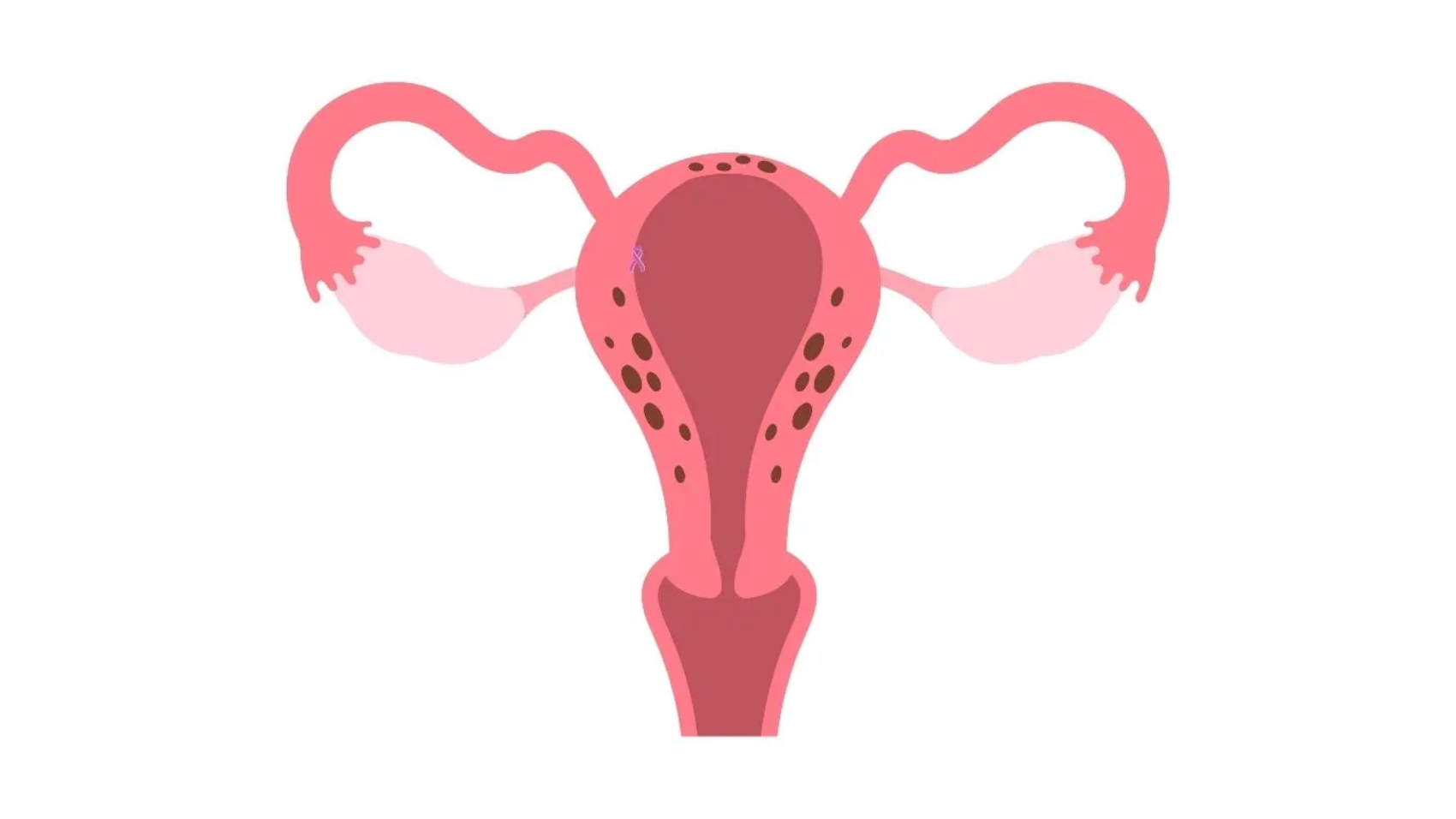 العضال الغدي