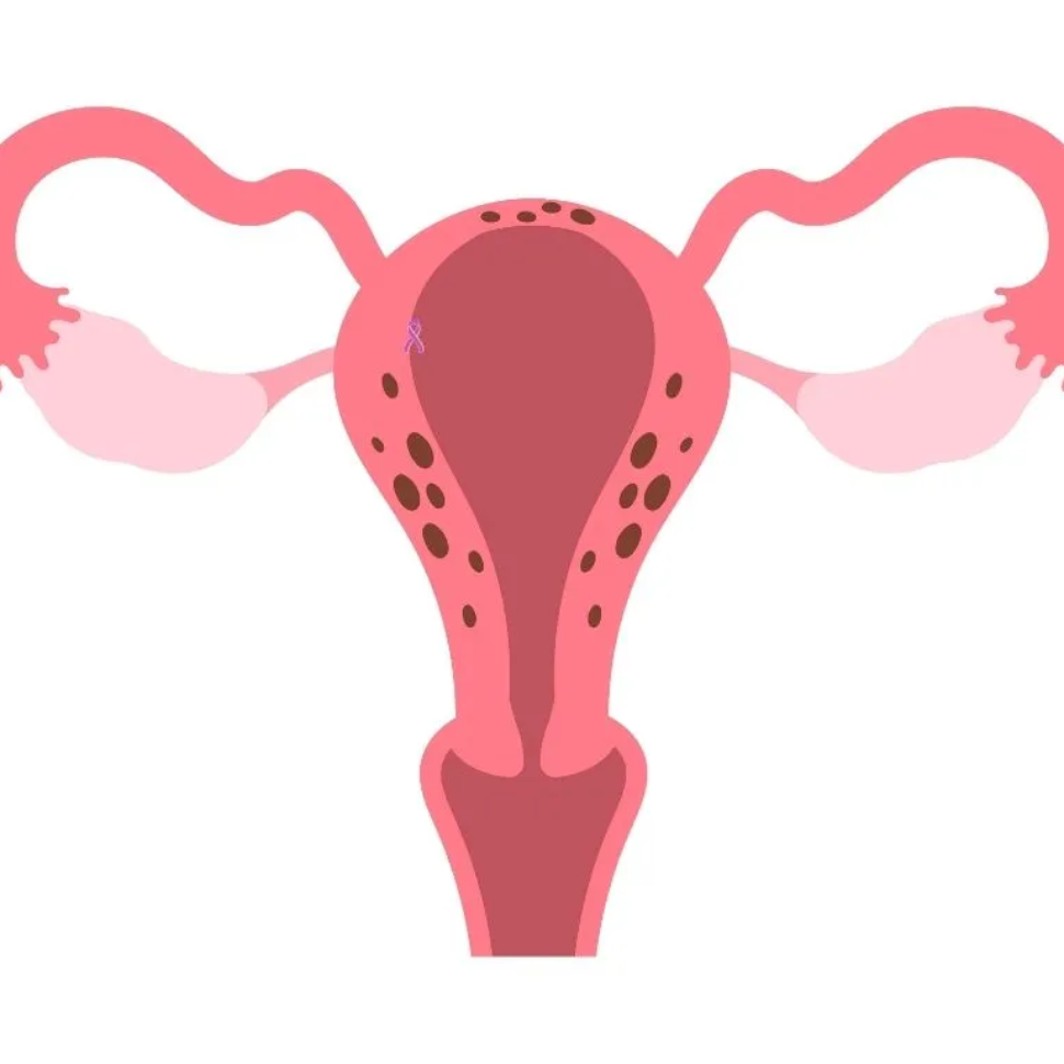 العضال الغدي